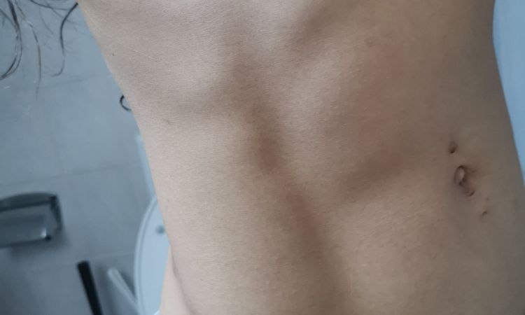 Injektionslipolyse bei Frauen für Definition am Bauch / sixpack? - 32943