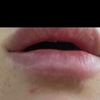 Lippenaufspritzen mit Hyaluron - Extrem schiefe Unterlippe, hilft massieren? - 32953