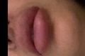Extreme Schwellung der Lippe nach 3 Monaten, Corona Virus Schuld? - 33011