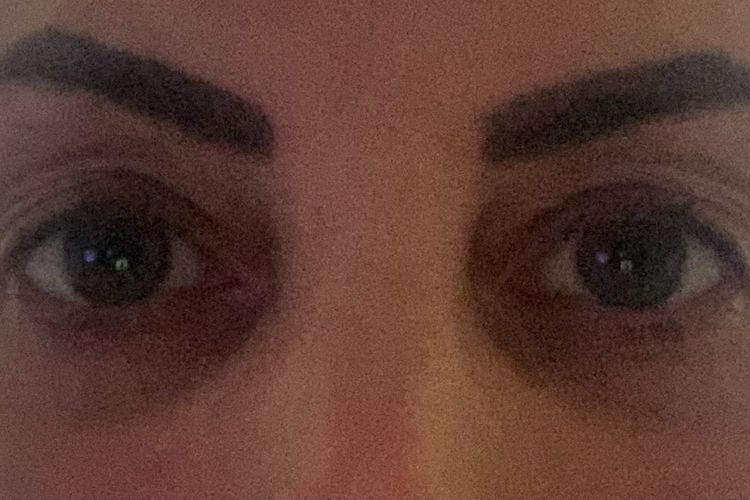 Augenringe 5 Wochen nach Unterlidstraffung, geht das noch weg? Estheticon.de