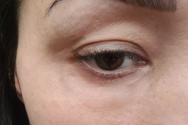 Schwellungen 3 Monate nach Unterlidstraffung, ist das ein Ödem oder Restfett? Estheticon.de
