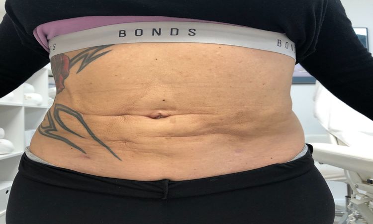 Verklebungen nach Liposuktion am Bauch nach 6 Monaten, was tun? - 33099