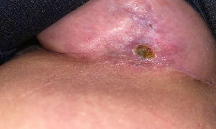 Wundheilungsstörung nach Bruststraffung mit Implantat? - 33227