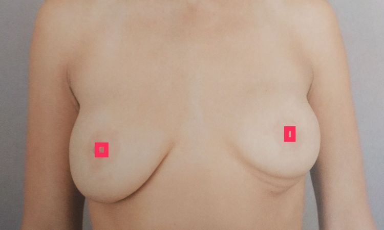 Zweifel: Brustimplantate Ruptur oder nur Verrutschte Brustimplantate? - 33260