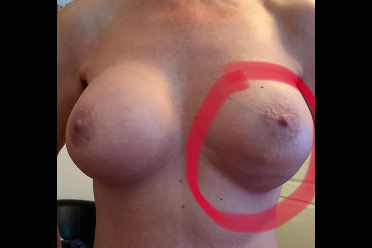 Double Bubble 16 Wochen post OP, hilft Stuttgarter Gürtel?