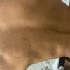 Alterswarzen entfernen, welche Möglichkeiten gibt es?