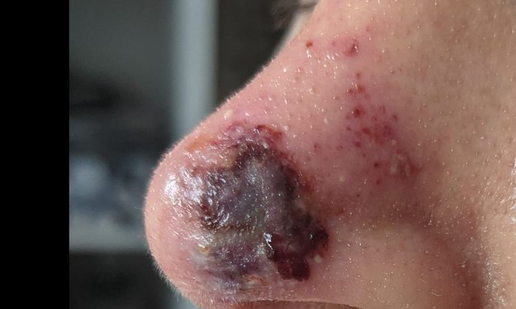 Entzündung nach Nasenkorrektur mit Hyaluron, was tun? - 33402