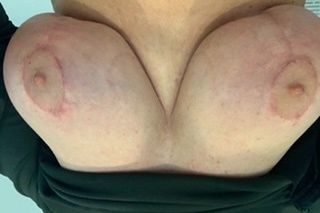 Bruststraffung - Brusthof gelb, was ist das? - 33528