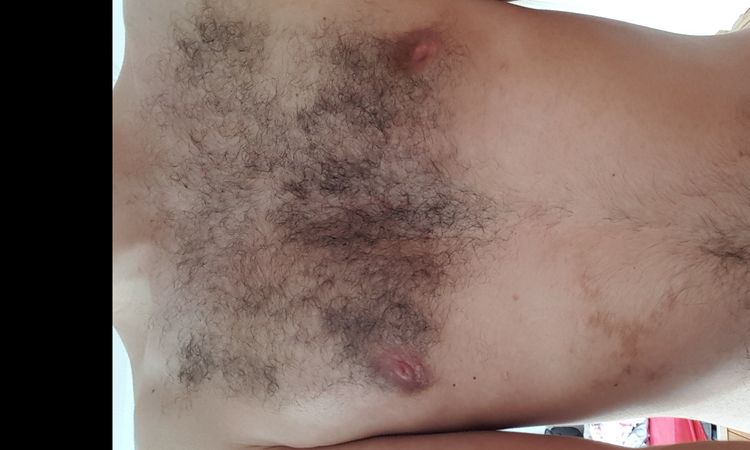 Nach Gynäkomastie-Op assymetrisches Ergebnis, wie ausbessern? - 33606