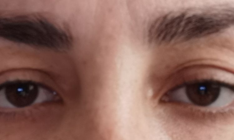 Blepharoplastik nur am äußeren Lid möglich? - 41457