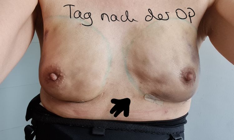 Brustvergrößerung mit Eigenfett nach Explantation, Asymmetie angleichen? - 41773