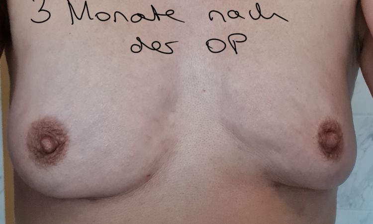 Brustvergrößerung mit Eigenfett nach Explantation, Asymmetie angleichen? - 41774