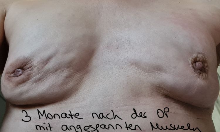 Brustvergrößerung mit Eigenfett nach Explantation, Asymmetie angleichen? - 41775