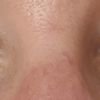 Augen Ptosis nach OP, kann man Haut an Oberlid entfernen?