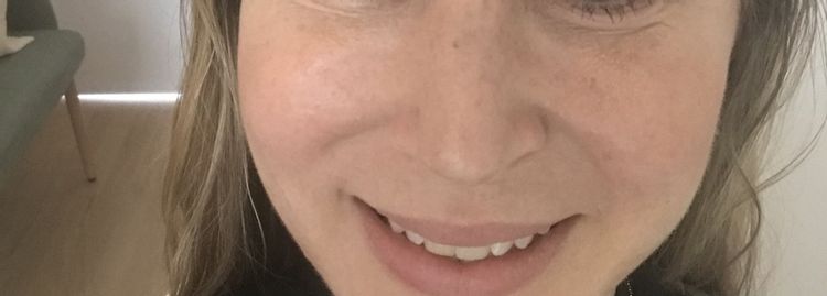 Asymmetrie nach Fettunterspritzung im Gesicht, was tun?