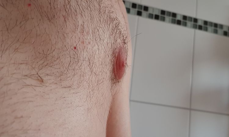 Gynäkomastie-OP, angehobene Brustwarzen, was kann man machen? - 42254