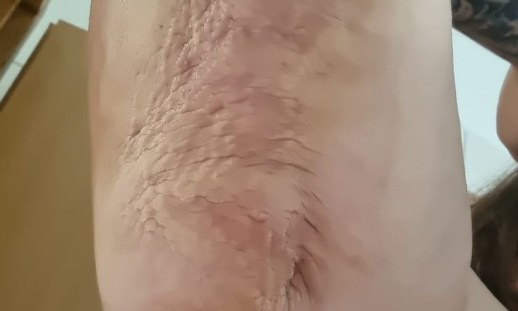 Verhärtungen 4 Wochen nach Fettabsaugung - 42627