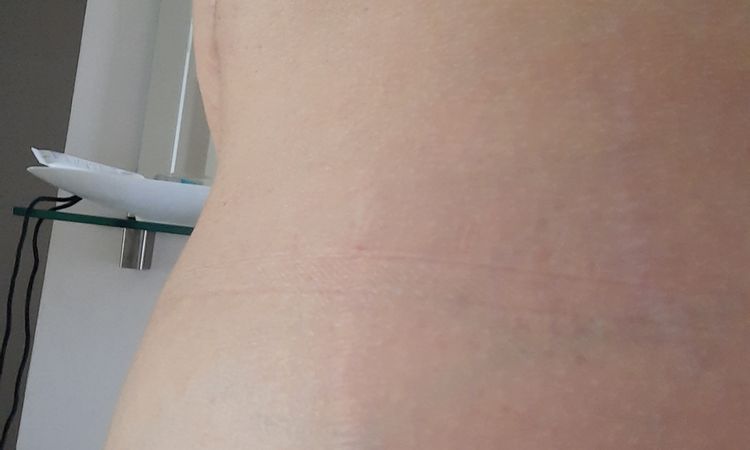 Schwellung Oberbauch ein Jahr nach Bodylift, Naht gedehnt? - 42923
