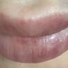 Blaue Lippen nach aufgespritzt mit 0,5 Hyaluron, ist das normal? - 43198