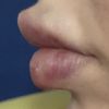 Blaue Lippen nach aufgespritzt mit 0,5 Hyaluron, ist das normal?