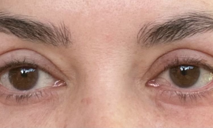 Probleme nach Unterlid OP - runde Augen und Kältegefühl? - 43793