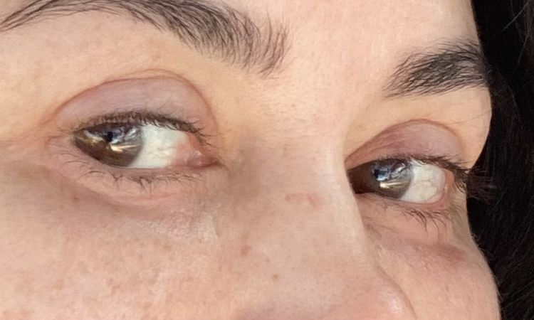 Probleme nach Unterlid OP - runde Augen und Kältegefühl? - 43795