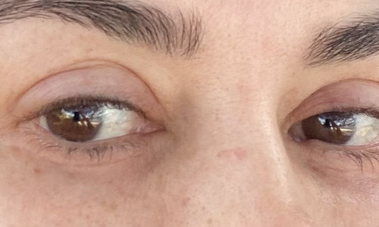 Probleme nach Unterlid OP - runde Augen und Kältegefühl? - 43796