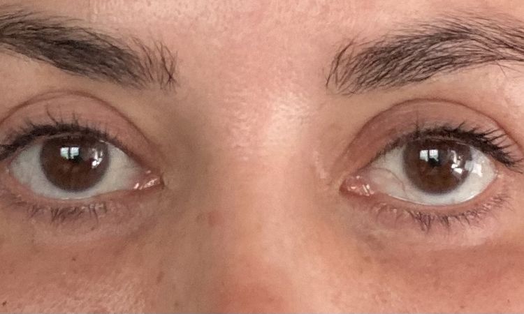 Probleme nach Unterlid OP - runde Augen und Kältegefühl? - 43800