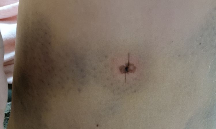 Heilung der Einstichstellen nach Liposuktion? - 44325