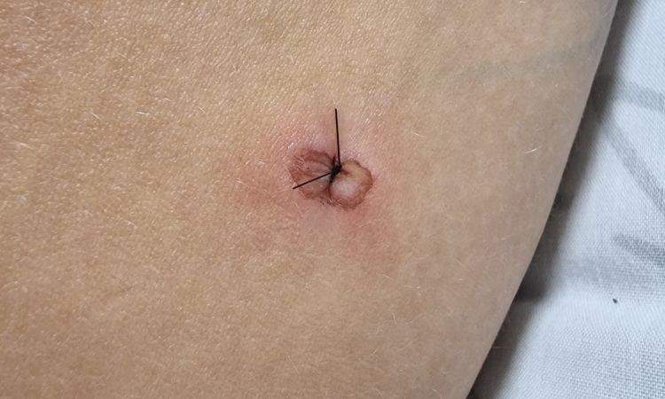 Heilung der Einstichstellen nach Liposuktion? - 44326