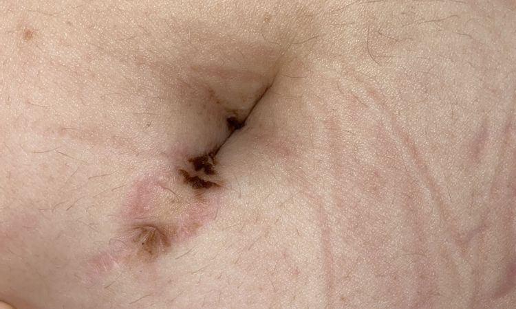Nach Schwangerschaft Narbe vom Bauchnabelpiercing, was tun? - 44870