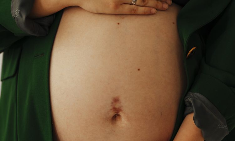 Nach Schwangerschaft Narbe vom Bauchnabelpiercing, was tun? - 44871