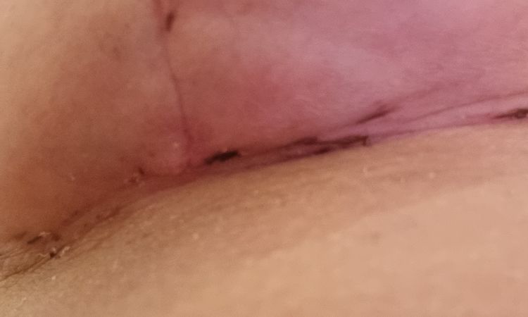Beule an Naht nach Brust-Op - 44925
