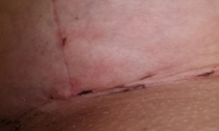 Beule an Naht nach Brust-Op - 44926