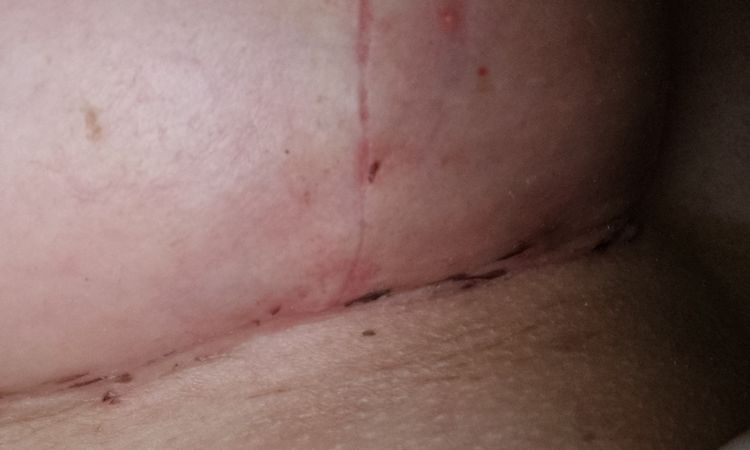 Beule an Naht nach Brust-Op - 44927