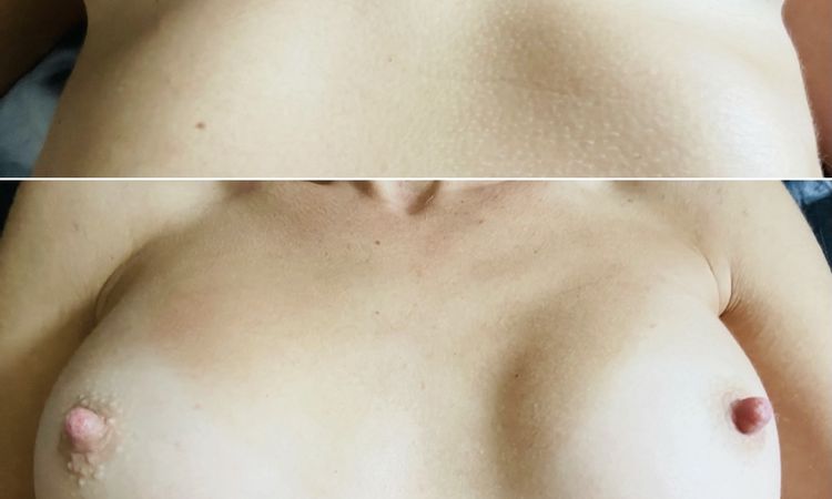 Asymmetrische Brüste nach Brustvergrößerung, wie korrigieren? - 45381