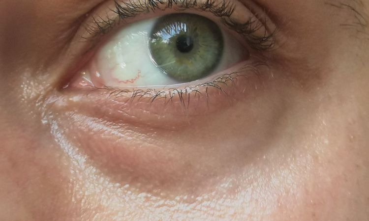 Augeninge - transkonjunktivale blepharoplastik mit Fettverteilung? - 45511