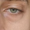 Augeninge - transkonjunktivale blepharoplastik mit Fettverteilung?