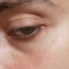 Augeninge - transkonjunktivale blepharoplastik mit Fettverteilung?