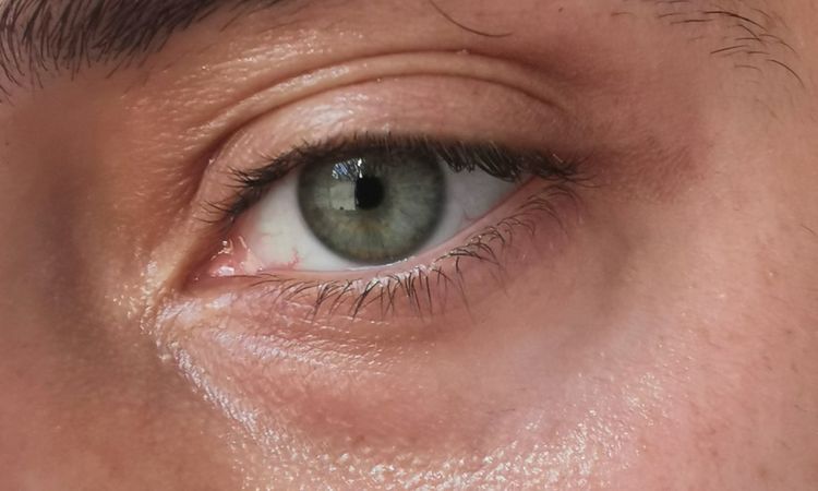 Augeninge - transkonjunktivale blepharoplastik mit Fettverteilung? - 45514