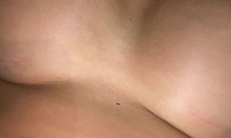 Haut zwischen Implantate legt sich nicht, ist das normal? - 46233
