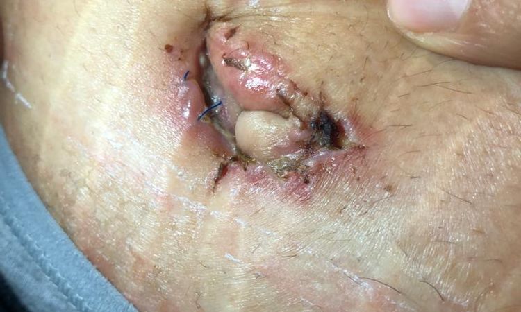 Bauchdeckenstraffung komischer Bauchnabel normal? - 46833