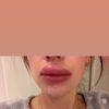 Geschwollene Lippen nach OP -  Lipofiller Allergie?