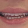 Fadenlifting Nase, Zähne plötzlich nicht mehr sichtbar beim Lachen