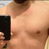 Absatz am Bauch 12 Monate nach Liposuktion