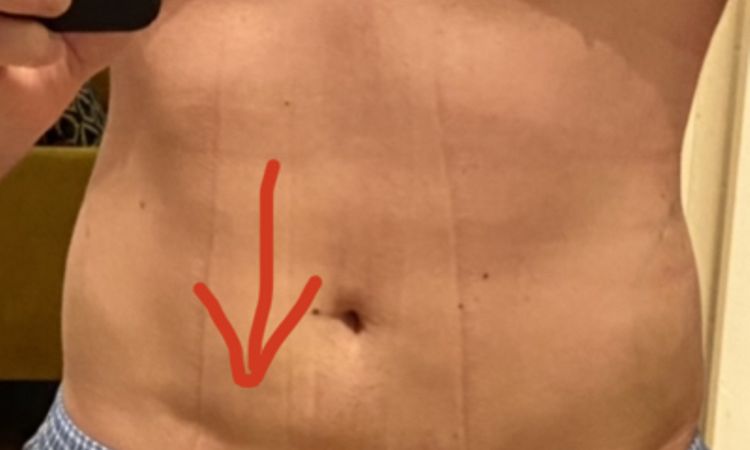Absatz am Bauch 12 Monate nach Liposuktion - 47945