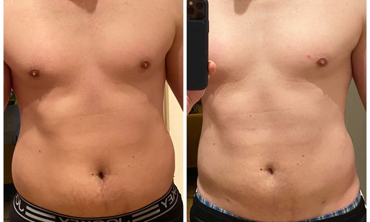 Absatz am Bauch 12 Monate nach Liposuktion - 47946