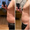 Absatz am Bauch 12 Monate nach Liposuktion
