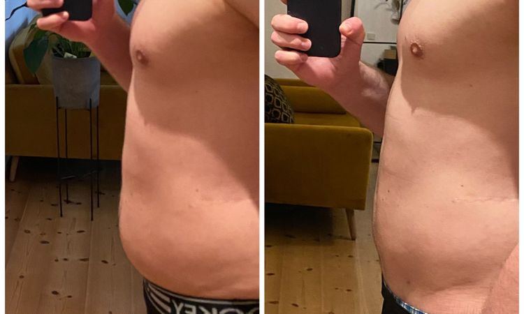 Absatz am Bauch 12 Monate nach Liposuktion - 47947
