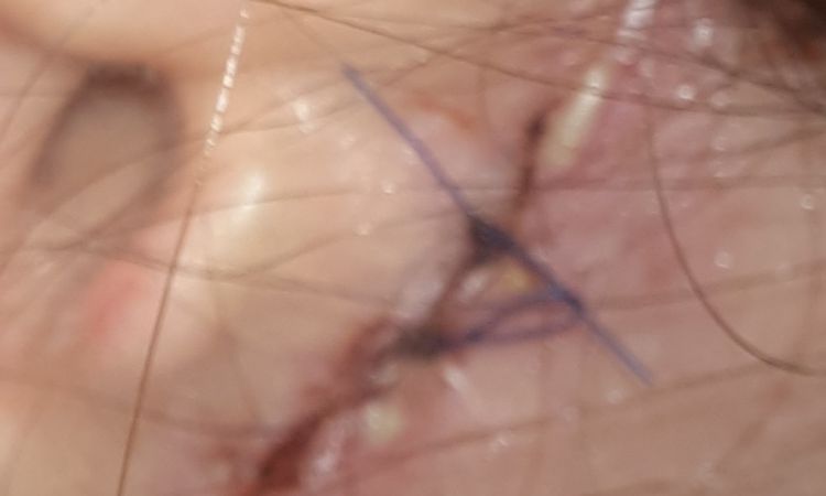Probleme nach einem Facelifting - 47985